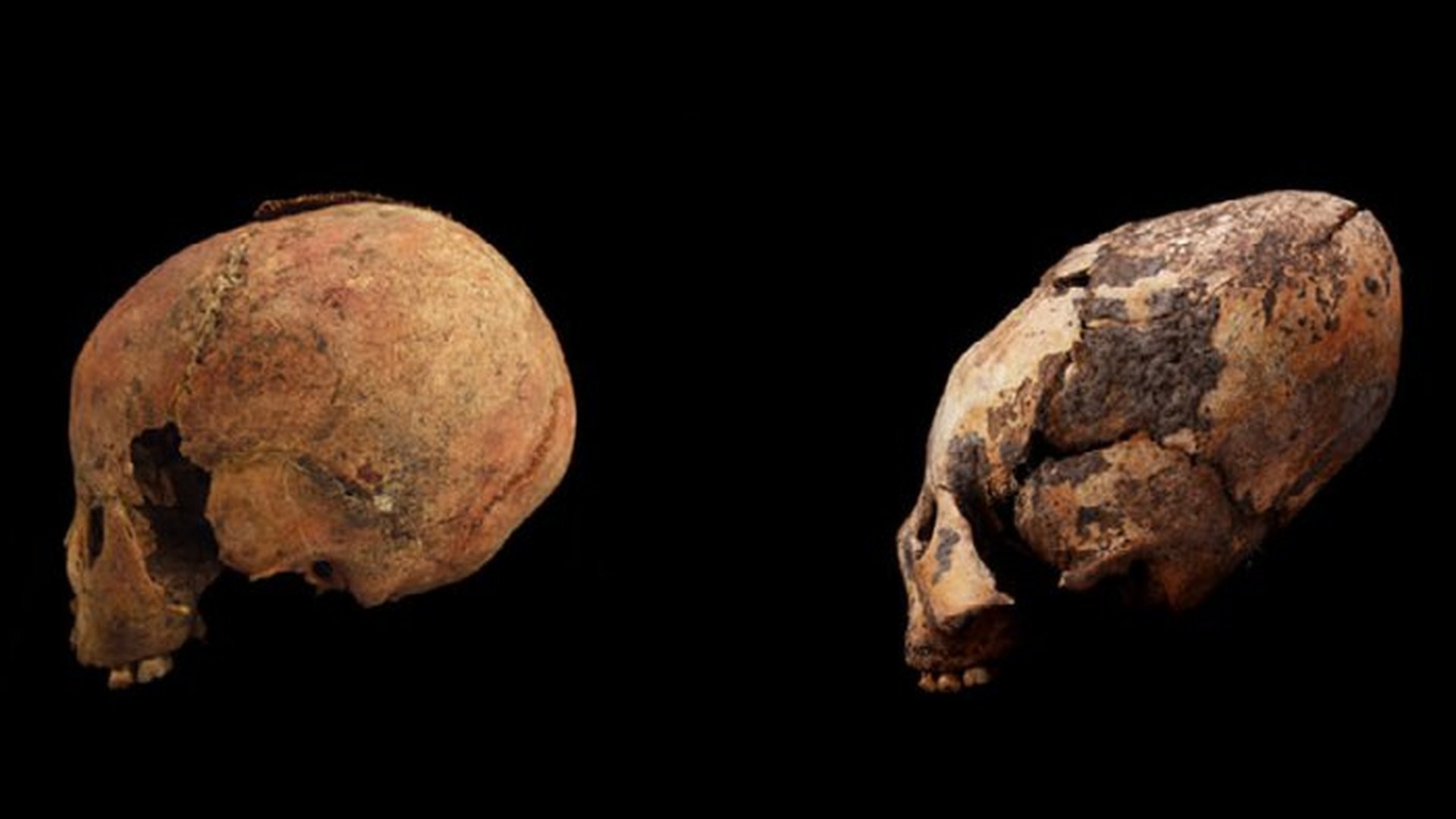 在中国发现了有12000年历史的变形头骨